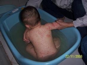 湿疹患者洗澡时要注意哪些事项，湿疹患者洗澡中不可忽略的细节